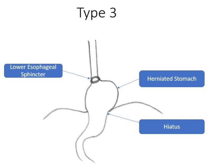 Hiatal Hernia Repair Houston Heartburn Center