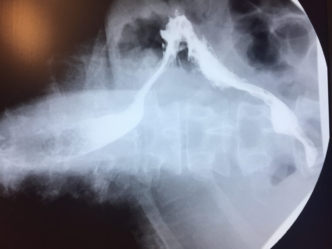 Does Nissen Fundoplication Affect the Magenstrasse