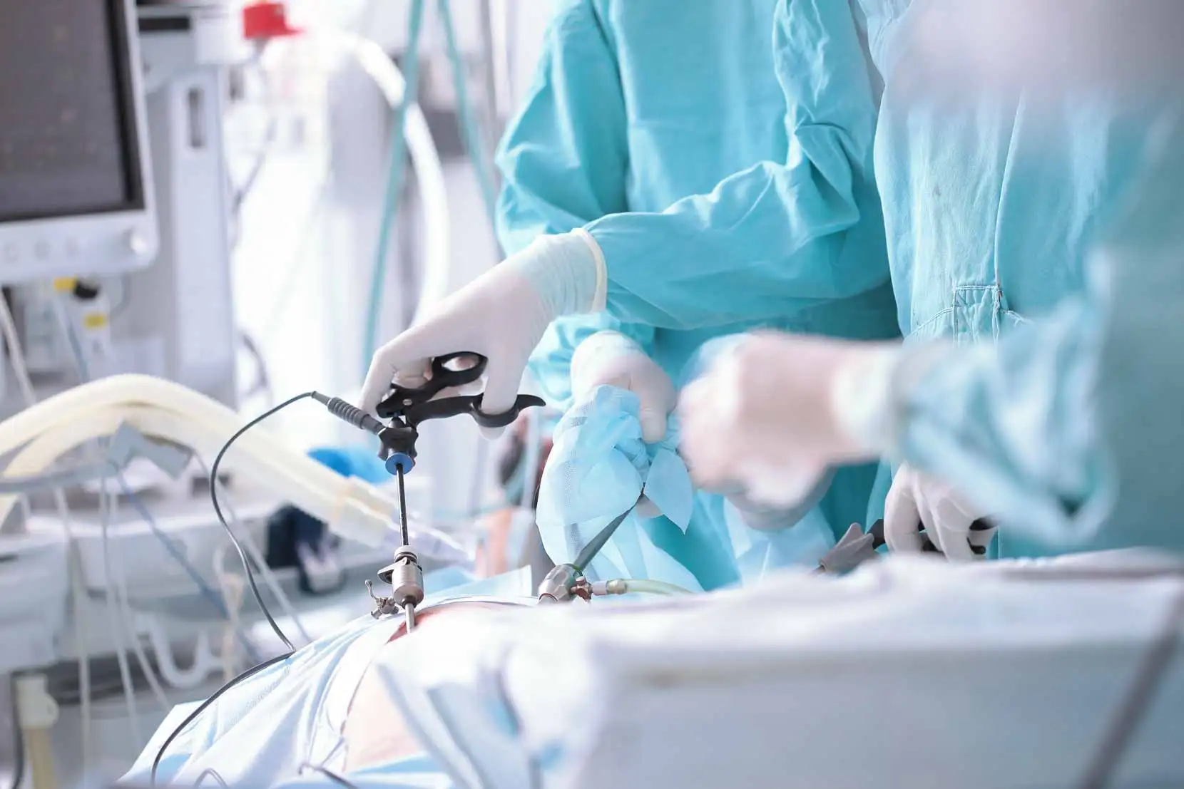 Laparoscopic view during an Antrum-Preserving Longitudinal Gastrectomy procedure